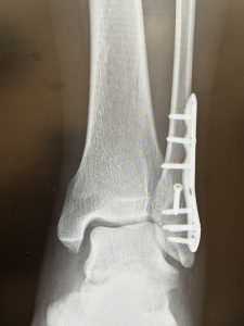 （長編）骨折のハナシ